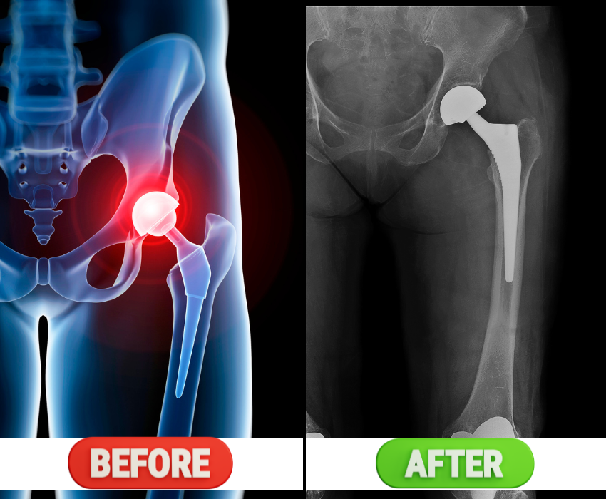 hip replacement result