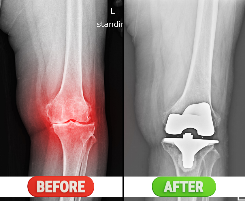 knee replacement result