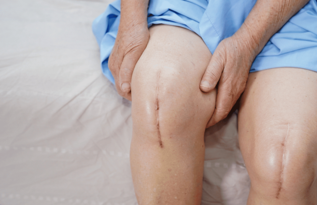 Knee Replacement in panchkula
