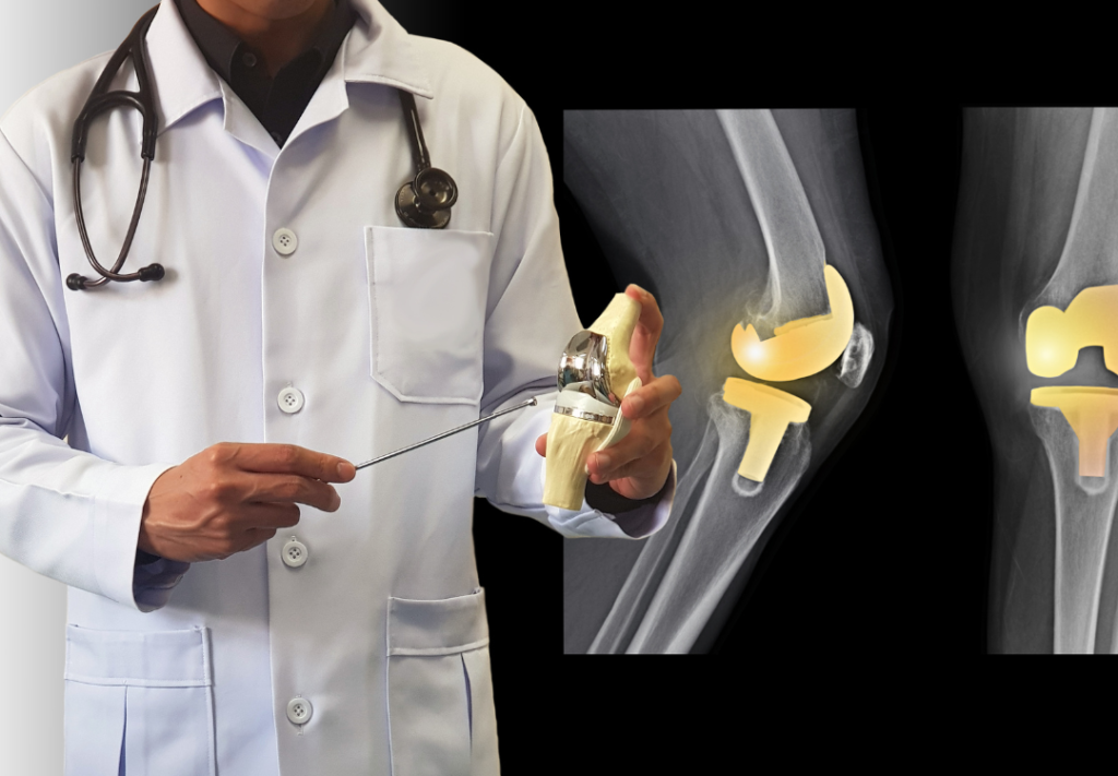 Top 5 Myths and Facts About Knee Replacement